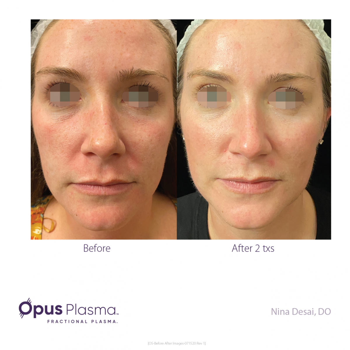 Opus-Before-and-After-B2C-1