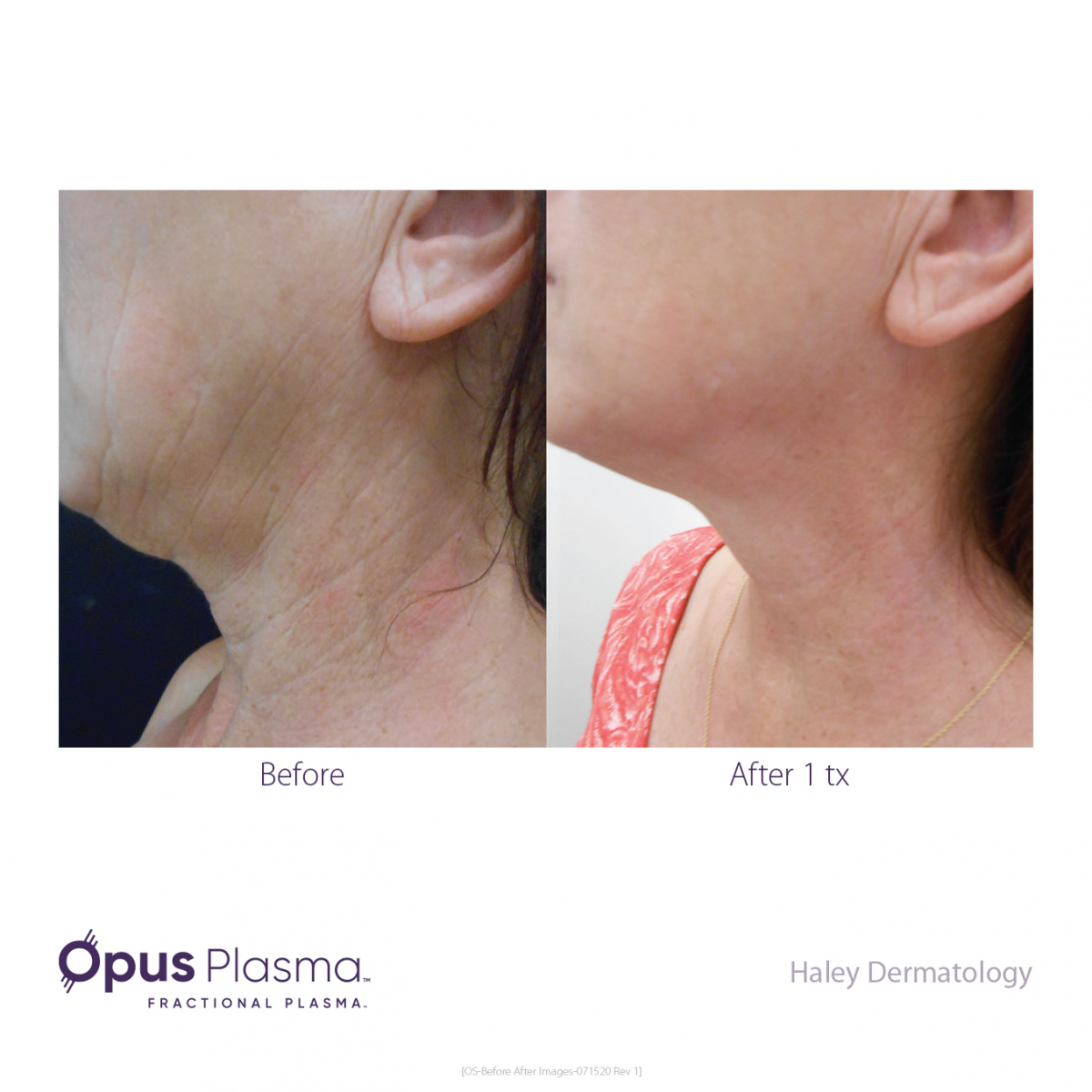 Opus-Before-and-After-B2C-10