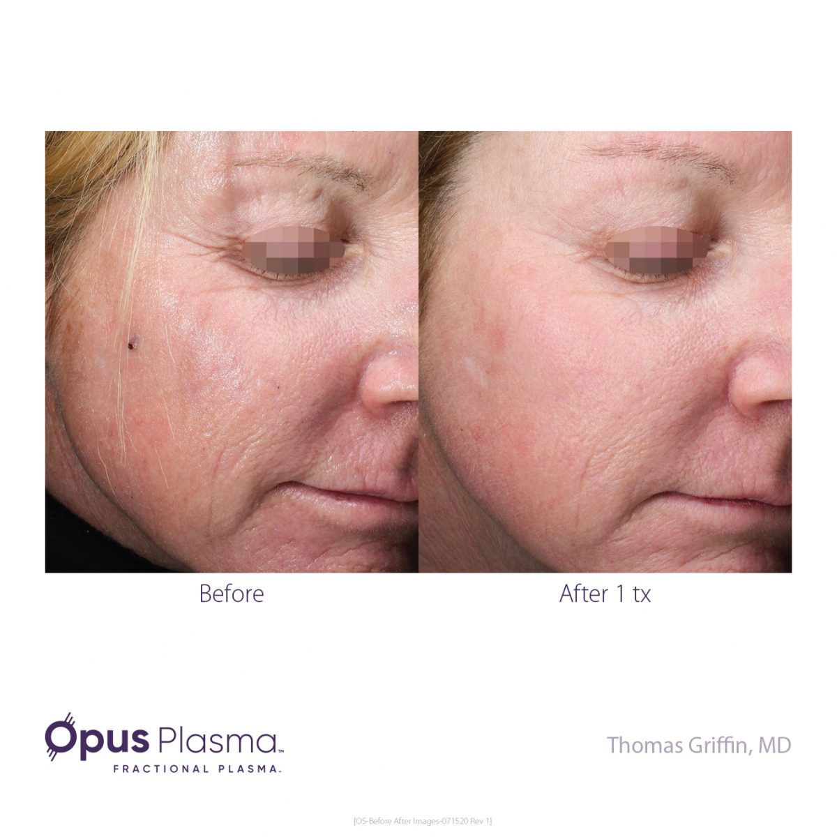 Opus-Before-and-After-B2C-11