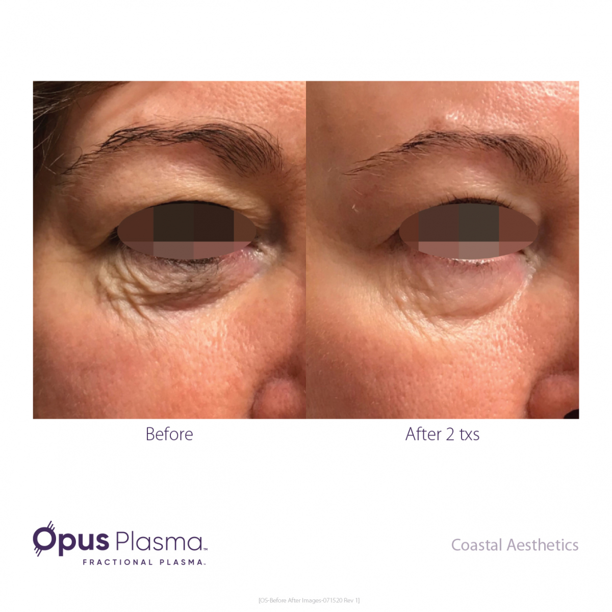 Opus-Before-and-After-B2C-14