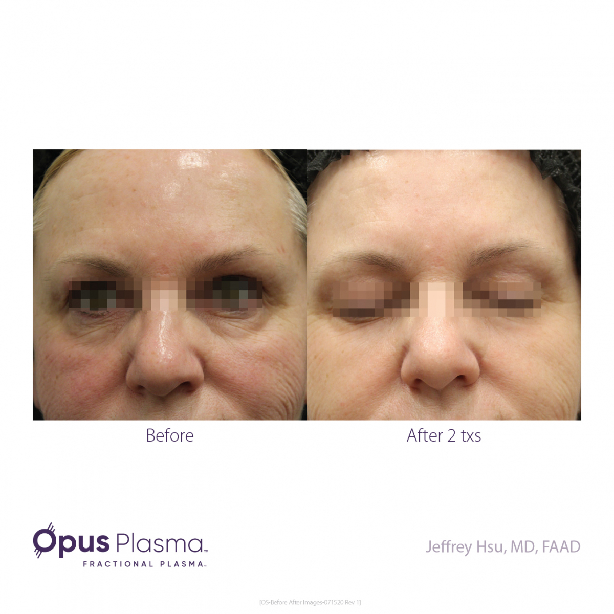 Opus-Before-and-After-B2C-5