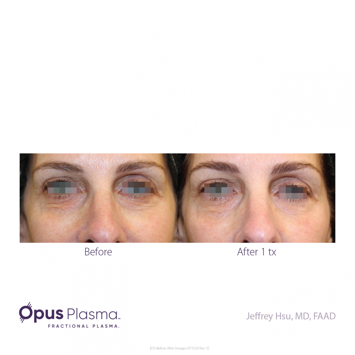 Opus-Before-and-After-B2C-6
