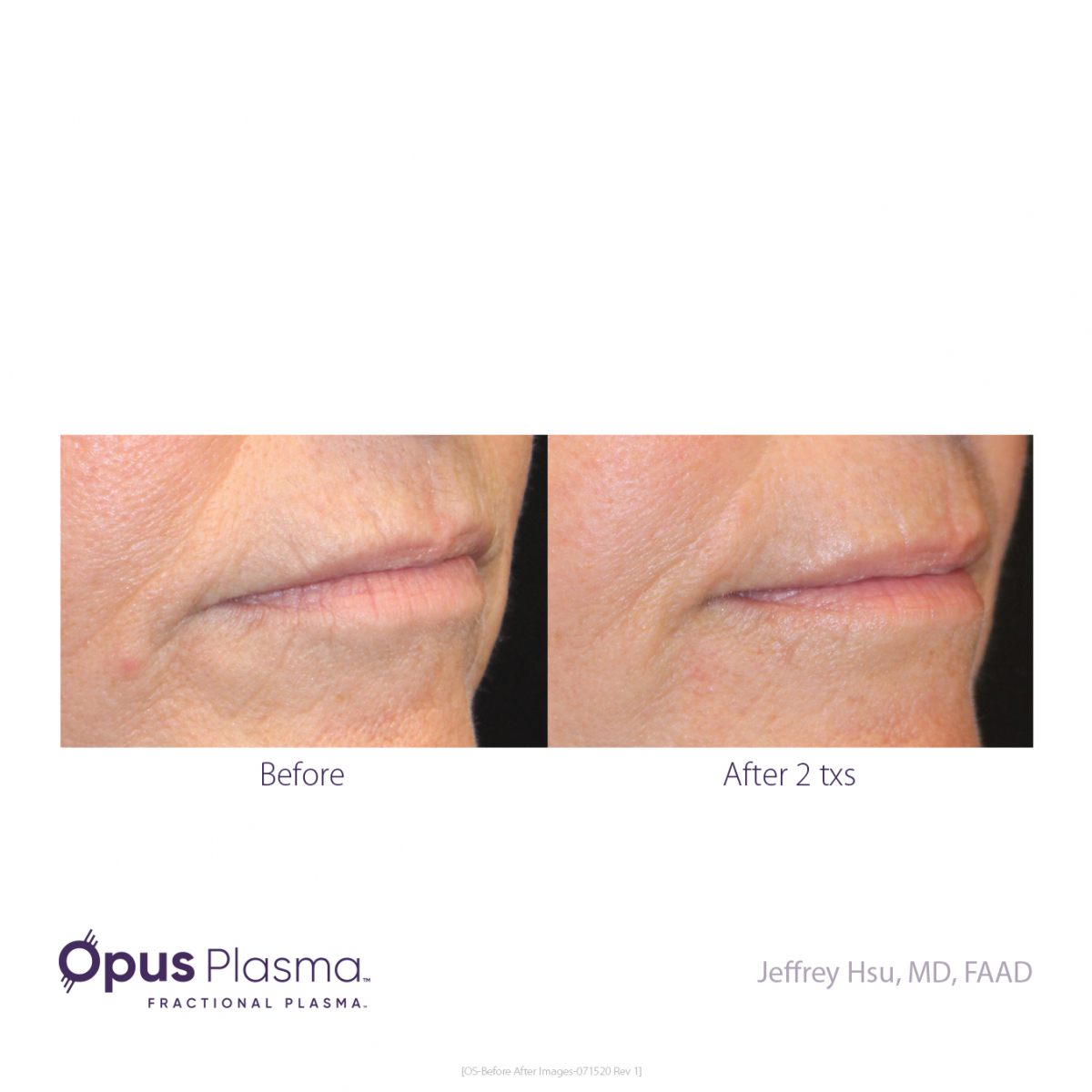 Opus-Before-and-After-B2C-9
