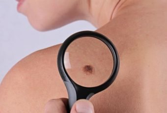 skin cancer screening san antonio