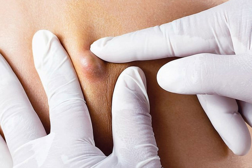 Is It Time to Consider Cyst Removal? 7 Things to Know