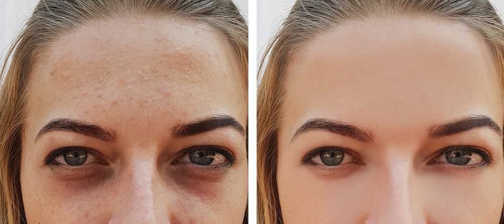 Red Bumps Under The Eyes: Causes and Effective Treatments