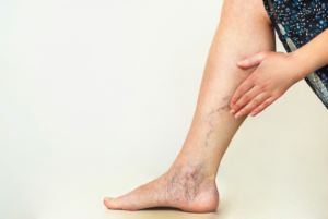 difference between spider veins and varicose veins