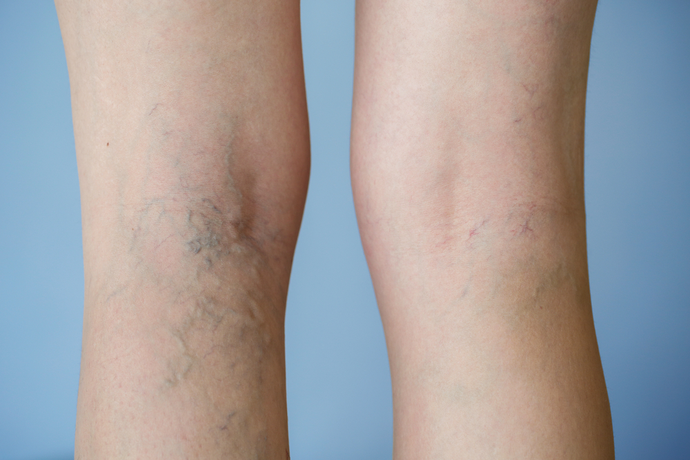 Can Spider Veins Come Back After Treatment? - Dermatologist in San
