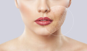 Laser Skin Resurfacing | Westover Hills Dermatology