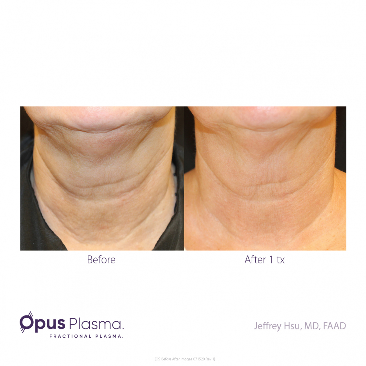Before and After Opus Plasma