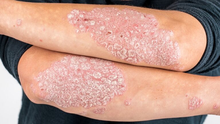 The Truth About Psoriasis: Causes, Symptoms, & Treatments