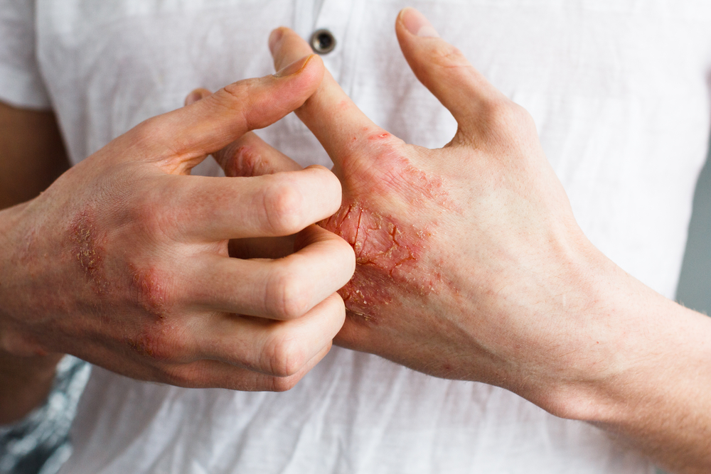 Eczema | Westover Hills Dermatology