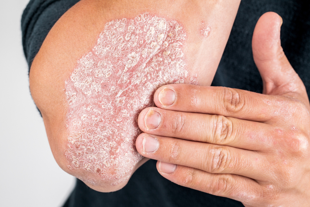 Psoriasis | Westover Hills Dermatology